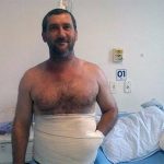 Бразильские врачи спасли руку пациента от ампутации, вшив ее в живот