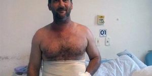 Бразильские врачи спасли руку пациента от ампутации, вшив ее в живот