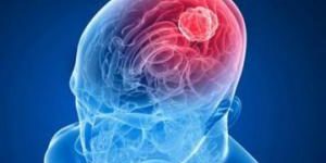Стволовые клетки могут быть ключом к лечению опухолей головного мозга